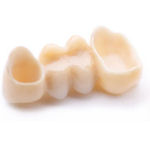 Stomatolog gdańsk oferuje protezy stałe